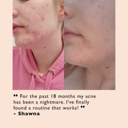 Acne-Attacker Skincare Bundle