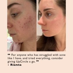 Acne-Attacker Skincare Bundle